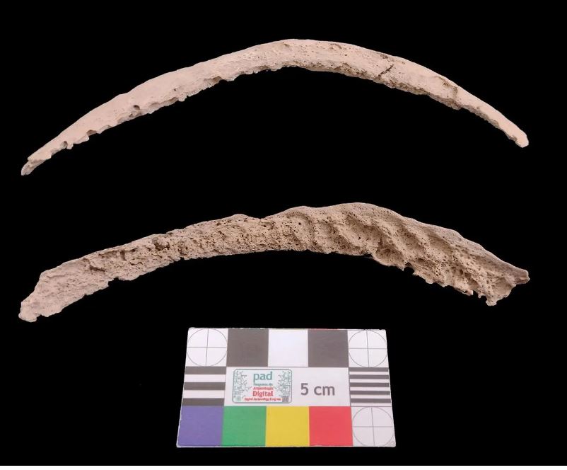 Syphilis originated in the Americas and spread to Europe through colonialism, ancient DNA reveals